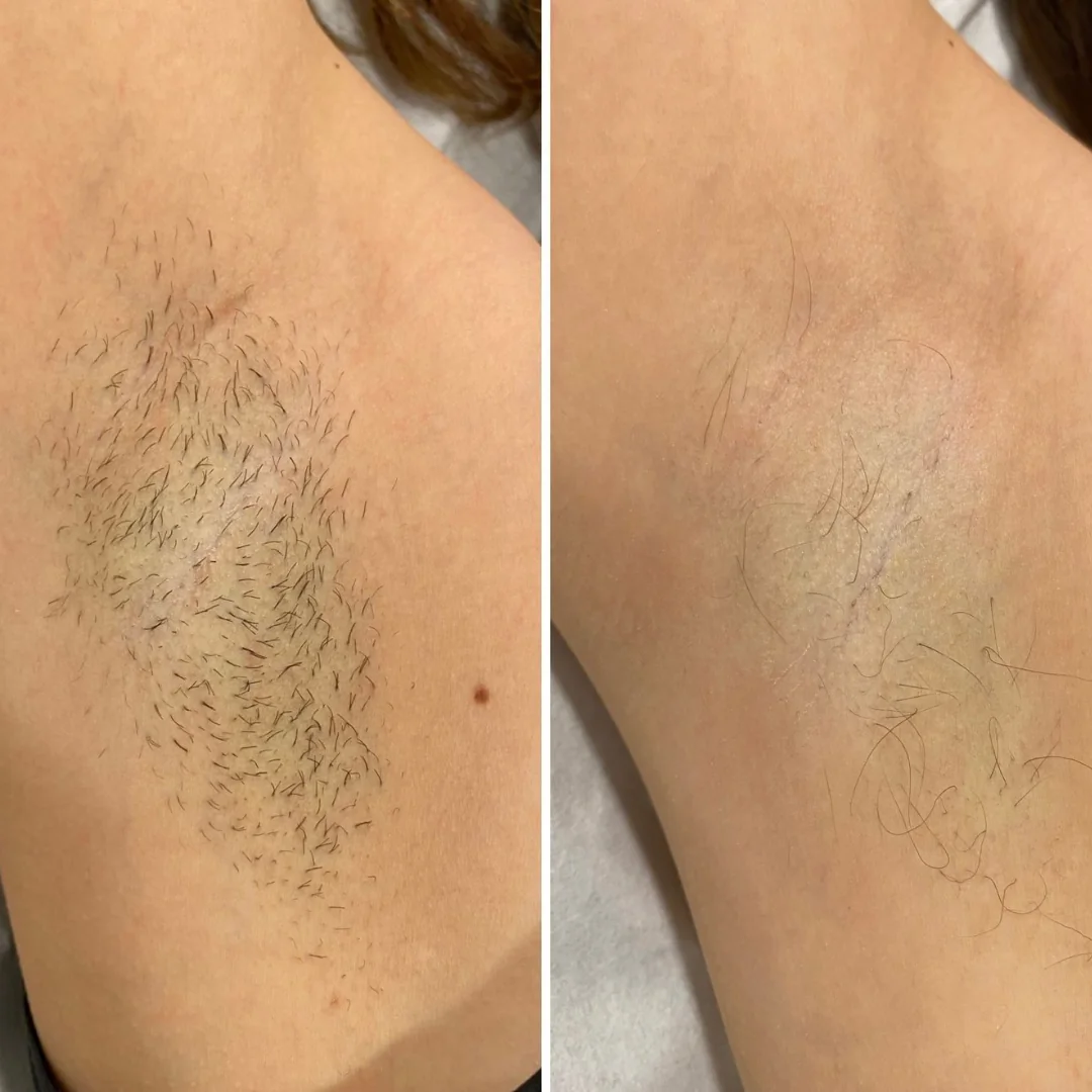 laser-ontharen-resultaat-oksel-skintastics Voor en na resultaat van laserontharing bij de oksel