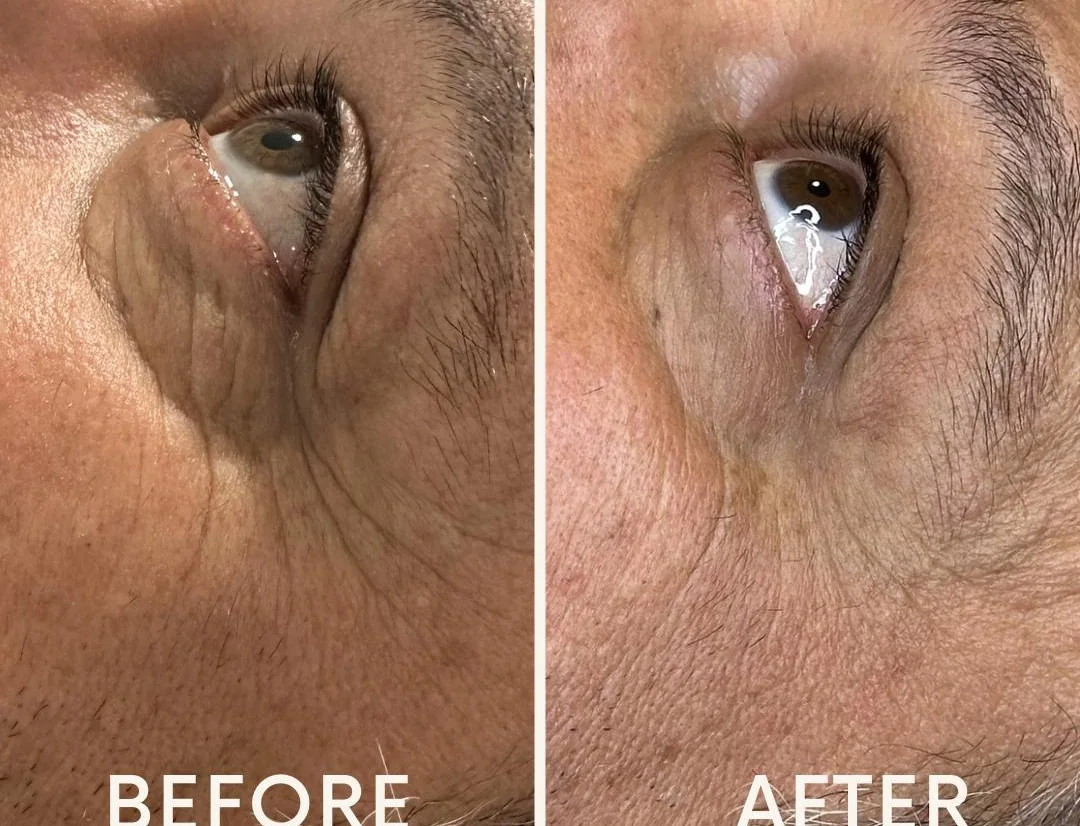 rrs-ha-eyes-voor-en-na-resultaat Voor en na resultaat rond de ogen na twee RRS HA Eyes behandelingen