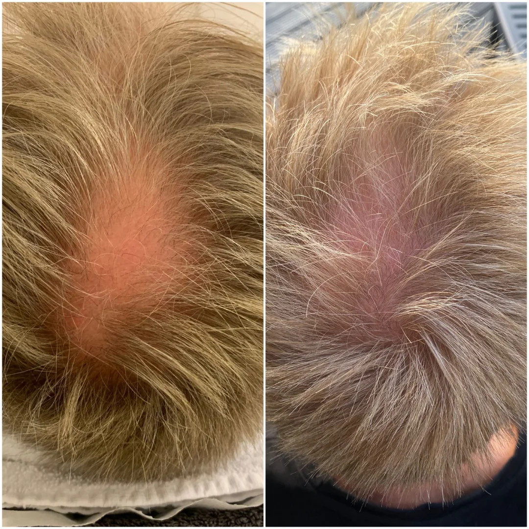 Voor-en-nafoto van de hoofdhuid bij een XL Hair traject bij Skintastics Rotterdam