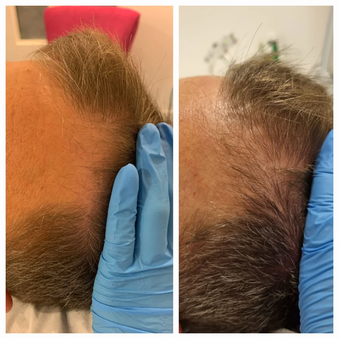 xl-hair-resultaat-haarlijn-skintastics-rotterdam Voor-en-nafoto van de haarlijn bij een XL Hair traject bij Skintastics