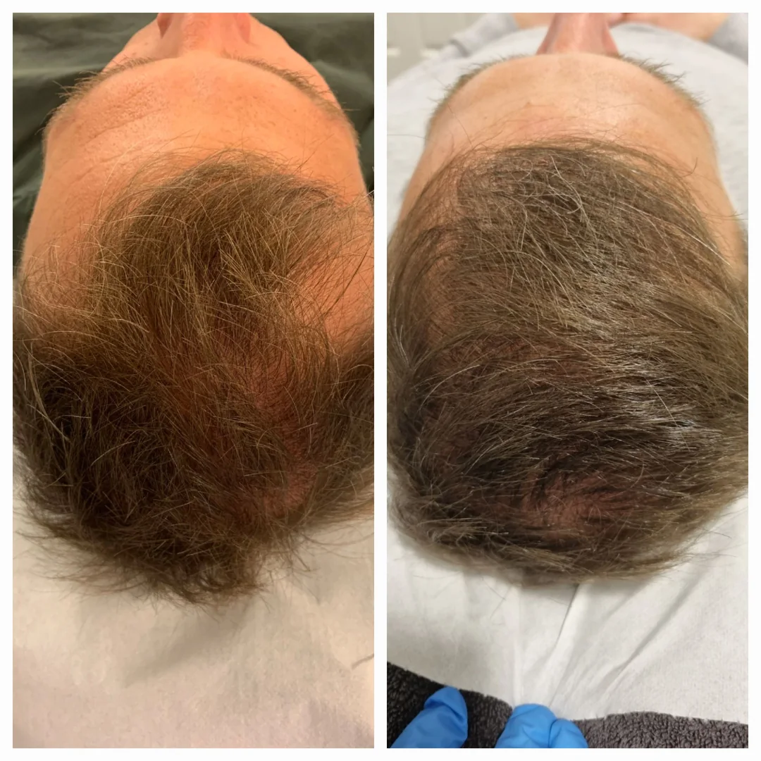 xl-hair-resultaat-kruin-skintastics-rotterdam Voor-en-nafoto van de kruin bij een XL Hair behandeling in Rotterdam
