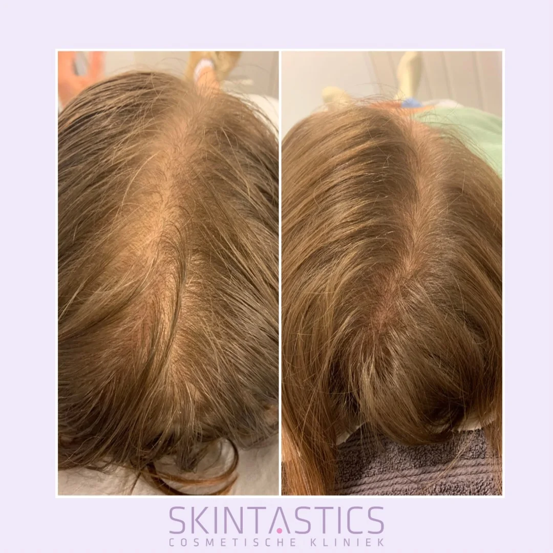 xl-hair-resultaat-vrouw-skintastics-rotterdam Voor-en-nafoto van dunner wordend haar na een persoonlijk XL Hair traject
