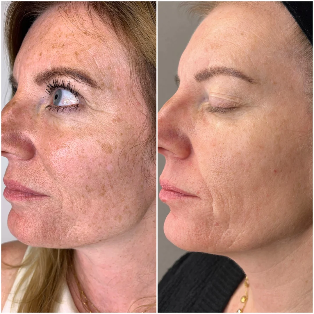 neogen-plasma-skintastics-rotterdam Zijaanzicht van een gezicht in twee naast elkaar geplaatste huidbeelden